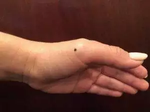 Acupressure point for sprained ankle
