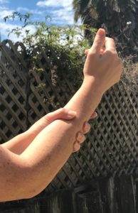 neuropathy carpal tunnel syndrome