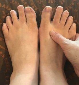 neuropathy in feet