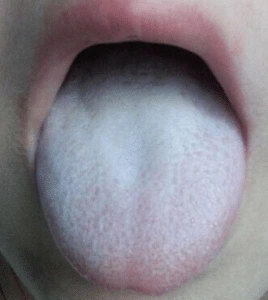 coated tongue