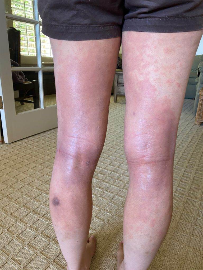 How to Treat Hives With Acupuncture and TCM » Art of Wellness