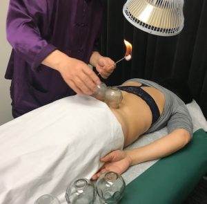 TCM cupping acupuncture