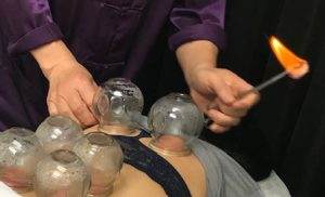 cupping acupuncture detox
