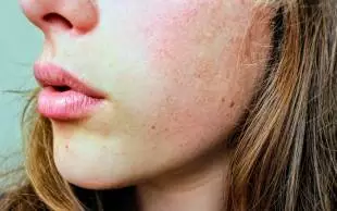 red, bumpy eczema rash