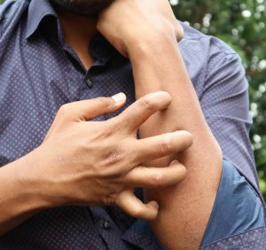 itching, itchy skin