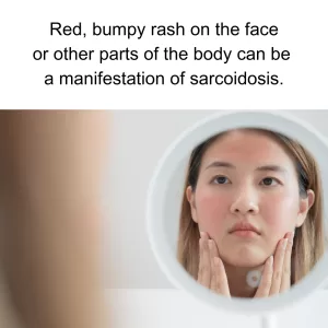 red bumpy rash on face
