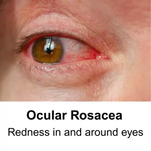 ocular rosacea - redness around eyes, bloodshot eyes